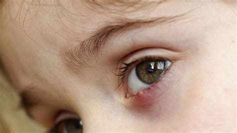 Ячмень на глазу лечение у ребенка