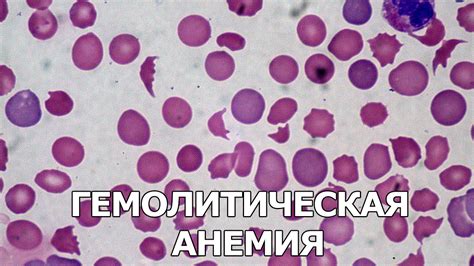 Гемолитическая анемия