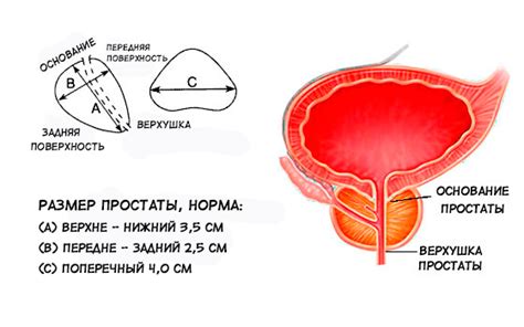 Гиперплазия предстательной железы у мужчин что это