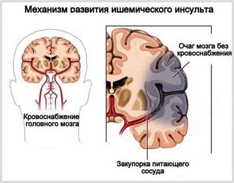 Инсульт головного мозга что это такое