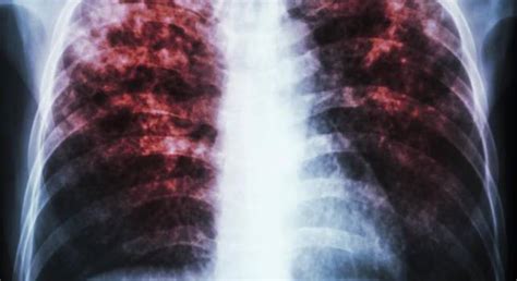 Каким путем передается туберкулез легких