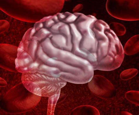 Кровоизлияние в мозг