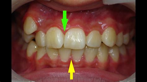 Неровные зубы
