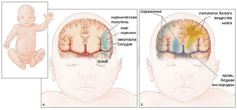 Узи головного мозга у новорожденных