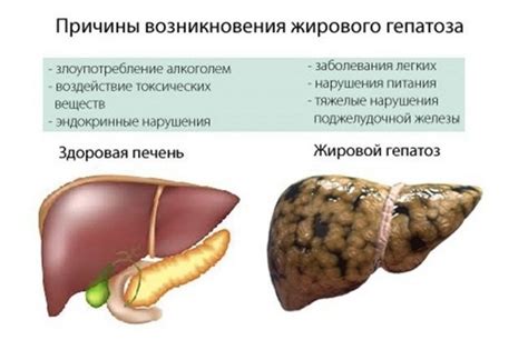 Жировой гепатоз печени лечение