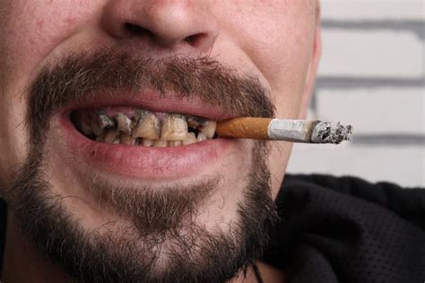 Можно ли курить после удаления зуба