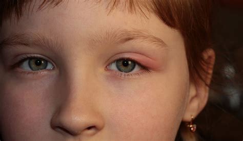 Ячмень на глазу лечение у ребенка